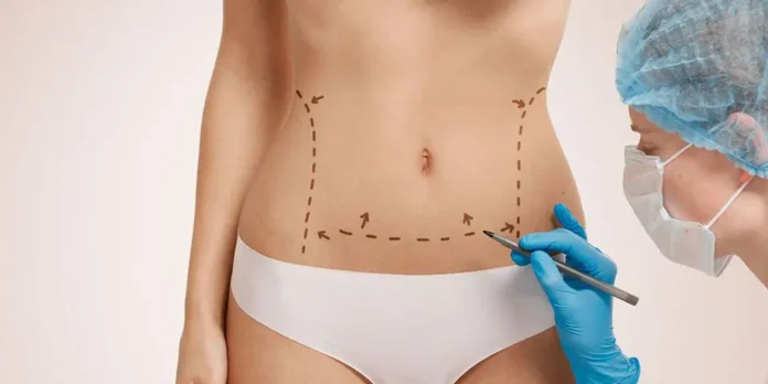 tummy tuck surgery cost in India