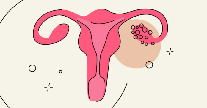 PCOD vs PCOS