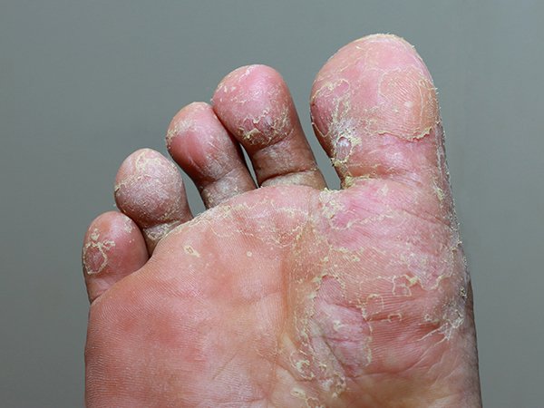 Athlete's Foot: Causes, Symptoms, Treatment